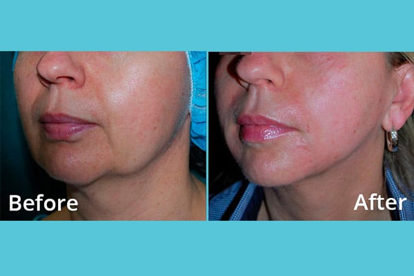 MORPHEUS Face & Body Rejuvenation