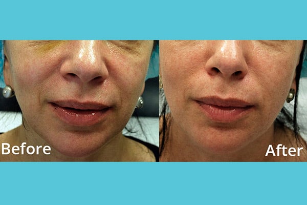 MORPHEUS Face & Body Rejuvenation